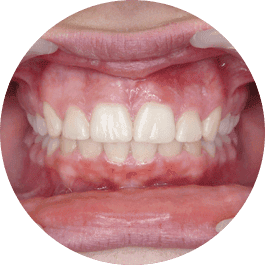Versiegelte Zähne